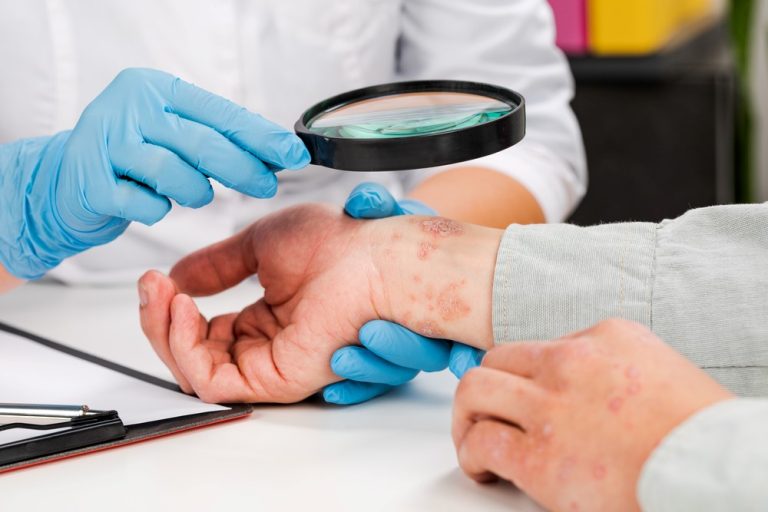 psoriazisului